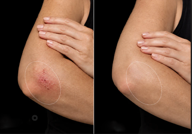 Wound Healing